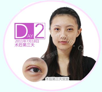 江娜：双眼皮果然电力十足
