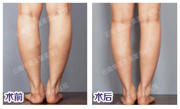 BOTOX瘦腿针效果
