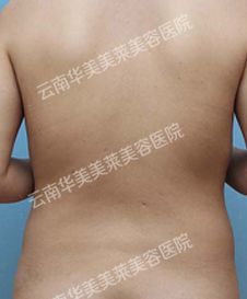 吸脂重塑纤美背部 我的吸脂经历分享