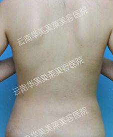 吸脂重塑纤美背部 我的吸脂经历分享