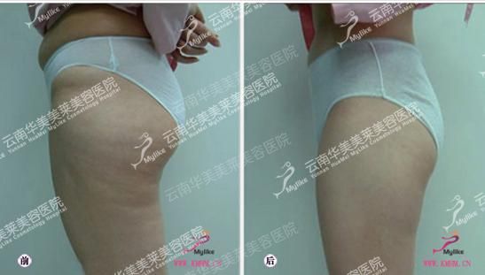 吸脂甩掉鸭梨臀 大婶华丽逆袭性感主妇