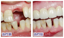 种植牙材料如何选择？