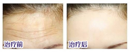 额头皱纹多怎么去除？