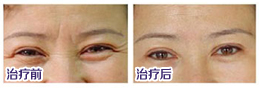 去除脸上皱纹好的方法是什么？