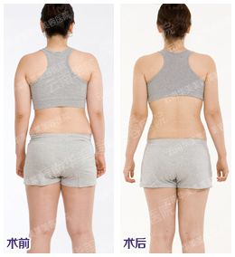 腰部吸脂减肥价格
