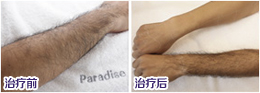 脱毛副作用有哪些，昆明脱毛哪里好？