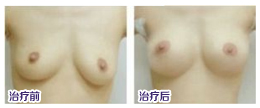 昆明乳房下垂矫正什么方法好？