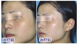 祛斑哪里好，美莱医学美肤祛斑效果怎么样？