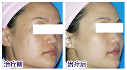 昆明治疗雀斑的医院哪家好？