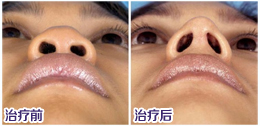 鼻头缩小手术多少钱？