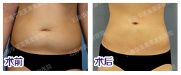 2014美莱春节吸脂特惠，让你瘦到好