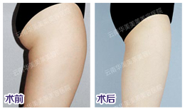 大腿吸脂减肥价格多少？
