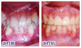 美莱牙齿矫正价格是多少？