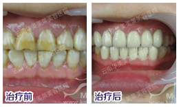 烤瓷牙价格是多少？