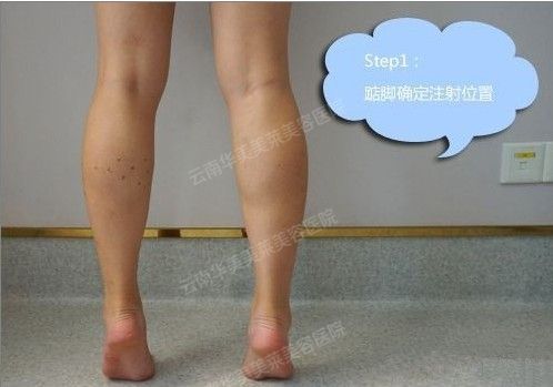 瘦小腿多少钱