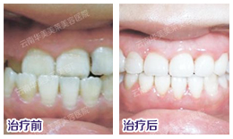 美容冠价格是多少？