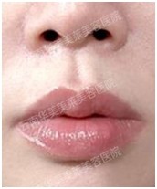 如何抵抗衰老? 微整形抗衰持续年轻呵护
