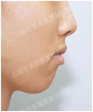 如何抵抗衰老? 微整形抗衰持续年轻呵护