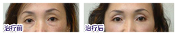 天生的眼袋如何去除？