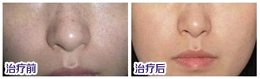快速下斑不做斑女郎