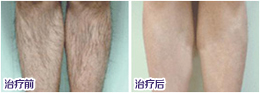医师介绍脱毛价格