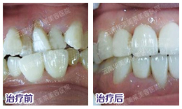 隐形矫正多少钱?