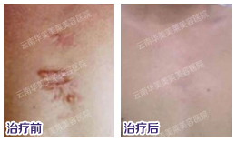 好的除疤方法