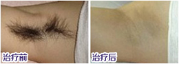 激光脱腋毛 长久