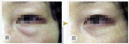 解决眼周问题  摆脱衰老痕迹