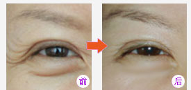 解决眼周问题  摆脱衰老痕迹