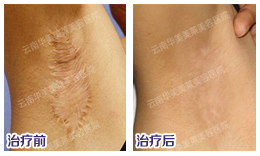 疤痕疙瘩怎么治疗