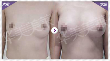 矫正乳房下垂，不让魅力走下坡路
