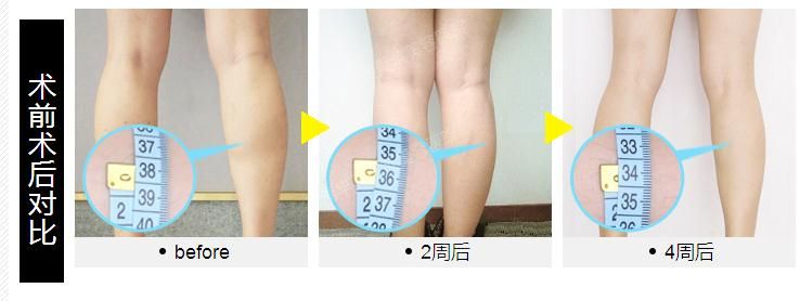 甩掉肌肉腿  重塑小腿曲线