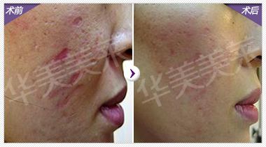 脸上的疤痕怎么去掉