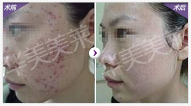 时尚美容法：微针去痘坑