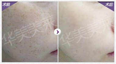 夏季美白技巧  分情况美白效果好