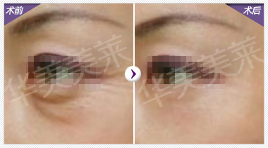 祛除眼角皱纹方法的比较