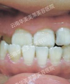 昆明美容冠多少钱？