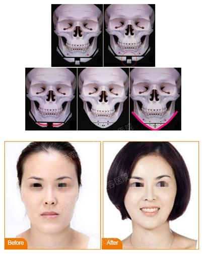 美莱韩式改脸型
