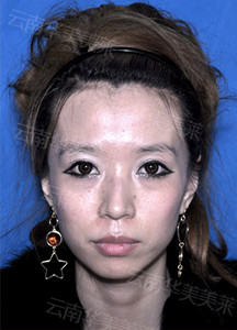 鼻子不够好看  韩式隆鼻可以拯救