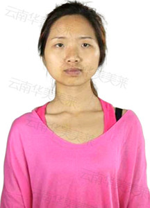 小脸精致更迷人 瘦脸如何更快速