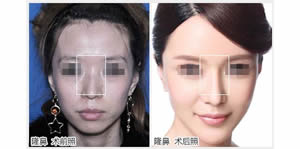 一针隆鼻针  就能提高你的时尚品味