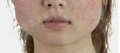 botox
