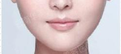 botox