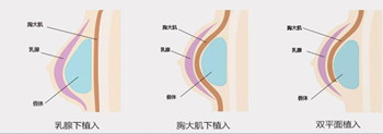 美莱假体隆胸效果