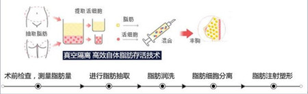 美莱自体脂肪丰胸效果