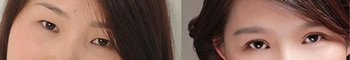 美莱双眼皮效果