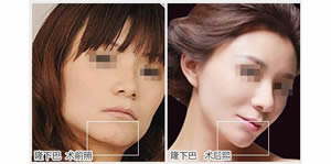 BOTOX瘦脸针！方脸型看过来