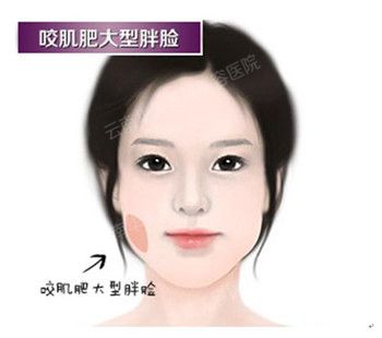 瘦脸针