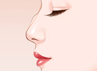 隆鼻